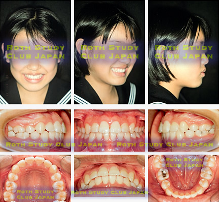 At the end of orthodontic treatment