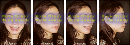 After orthognathic surgery